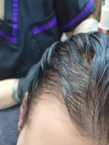 Tratamiento Alopecias y caídas