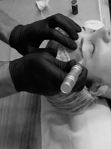 Tratamiento recuperación de cejas